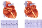 Dùng thuốc điều trị rối loạn nhịp tim nhóm III: Các khuyến cáo đặc biệt
