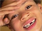 Nhổ răng sữa có bị sót chân răng?