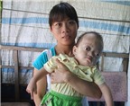 Cứu bé mắc bệnh “lồi mắt” hiếm gặp