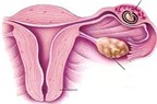 Điều trị bảo tồn ống dẫn trứng trong thai ngoài tử cung