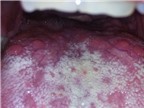 Nổi nhiều hạt đỏ dưới lưỡi, có phải bệnh ung thư?
