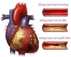 Cách phòng ngừa nhồi máu cơ tim