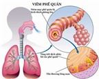 Chăm sóc trẻ bị viêm phế quản phổi