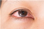 Dùng đúng thuốc trị đau mắt đỏ