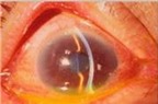 Nguyên tắc “vàng” phòng bệnh đau mắt đỏ
