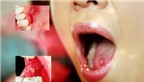 Nguyên nhân, triệu chứng và phòng bệnh viêm loét miệng lưỡi