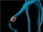Hạt phóng xạ có thể điều trị tận gốc bệnh ung thư vú
