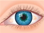 Mắt có chấm vàng ở tròng trắng là bệnh gì?
