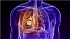 Bí quyết đơn giản phòng tránh ung thư phổi