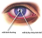 Những bệnh ở mắt có thể dẫn đến mù lòa