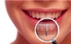Gãy 4 răng cửa trên, làm răng sứ hay cắm Implant tốt hơn?