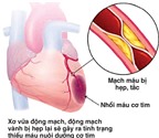 Sử dụng nitroglycerin trong điều trị bệnh tim mạch