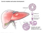Những biểu hiện của bệnh ung thư gan