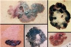Cận cảnh sự tàn phá do ung thư da