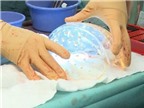 Hà Lan: Cấy ghép thành công hộp sọ 3D cho một phụ nữ