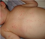 5 bước chăm sóc đúng cách trẻ sốt phát ban tại nhà