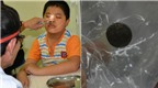Đà Nẵng: Pin nằm trong mũi bệnh nhi 10 tuổi suốt 5 năm