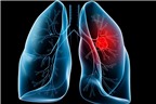 Dấu hiệu nhận biết ung thư phổi ở trẻ