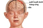 Chỉ 54% ca xuất huyết màng não có triệu chứng nhức đầu