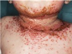 Ngừa được ung thư da nhờ có eczema?