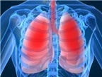 Nguyên nhân nào dẫn đến bệnh áp xe phổi?