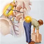 Khắc phục chứng đau thắt lưng