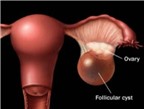 Điều phụ nữ cần biết về ung thư buồng trứng