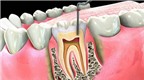 AloBacsi ơi, việc lấy tủy có ngăn ngừa sâu răng tái phát?