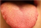 11 dấu hiệu bất thường của lưỡi báo hiệu bạn mang bệnh hiểm