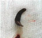 Con vắt dài 4cm sống hơn 10 ngày trong mũi bệnh nhi ở Hà Giang