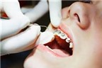 AloBacsi ơi: Chỉnh răng có ảnh hưởng tới sức khỏe?