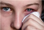 Nguyên tắc chăm con trẻ bị đau mắt đỏ