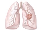 Cận cảnh sự tàn phá khủng khiếp của ung thư phổi