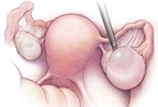 Bệnh u nang buồng trứng và nỗi lo biến chứng