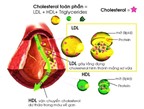 Điều hòa cholesterol làm giảm 74% nguy cơ nhồi máu cơ tim