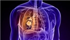 Bệnh ung thư phổi: Có thể chẩn đoán sớm qua máu