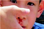 Chảy máu cam ở trẻ em: xử trí và phòng ngừa
