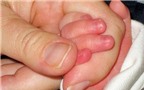 Trẻ bị cước tay chân: Mẹo chữa trị hiệu quả