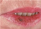 Những điều nên biết về ung thư môi