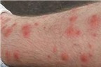 Hội chứng vết loét - hạch - ban trong bệnh sốt mò