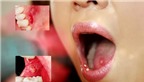 Một số bệnh thường gặp ở miệng