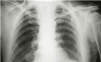 Thuốc điều trị bệnh viêm phổi