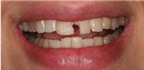 Răng tự nhiên bị mẻ là bị bệnh gì?