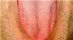 Có thể phát hiện 14 bệnh qua dấu hiệu của lưỡi