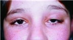 Dấu hiệu sớm của bệnh sa mí mắt