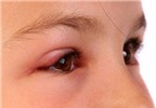 Những biểu hiện ở trán và mắt nói lên bệnh gì?