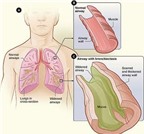 Biến chứng của bệnh lao phổi