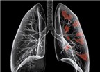 Những biểu hiện của bệnh ung thư phổi
