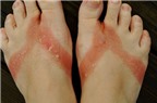 Đi dép tông dễ mắc các bệnh ở chân