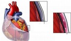 Viêm màng ngoài tim: Nguyên nhân và triệu chứng